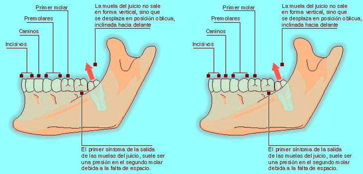 La muela apocalíptica