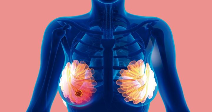 Ofrecen revisiones gratuitas para detectar cáncer de mama