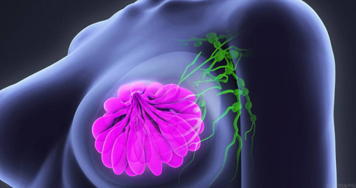 Fallecen 12 mujeres al día por cáncer de mama en México*