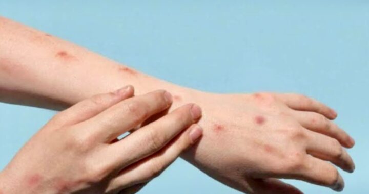 Sigue monitoreo epidemiológico para reducir riesgos de contagio de la viruela símica