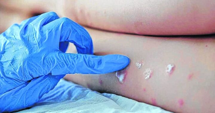 Se confirma un caso más de viruela símica en Guanajuato, ya son 9