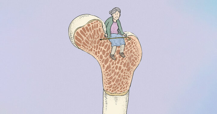 La osteoporosis afecta a 10 millones de mexicanos*