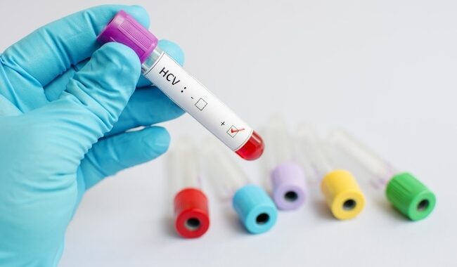 Confirman primera muerte de hepatitis en Guanajuato, era un menor de edad