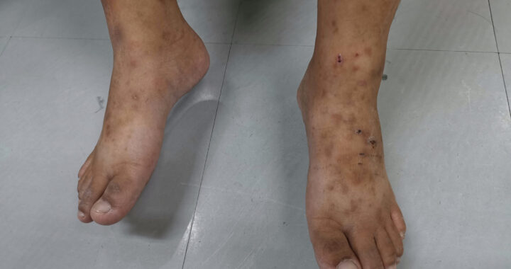 Pacientes con diabetes pierden extremidades por falta de cuidados
