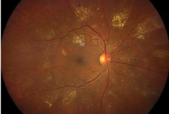 Desarrollan UG algoritmo para el análisis de fondo de ojo en pacientes con diabetes