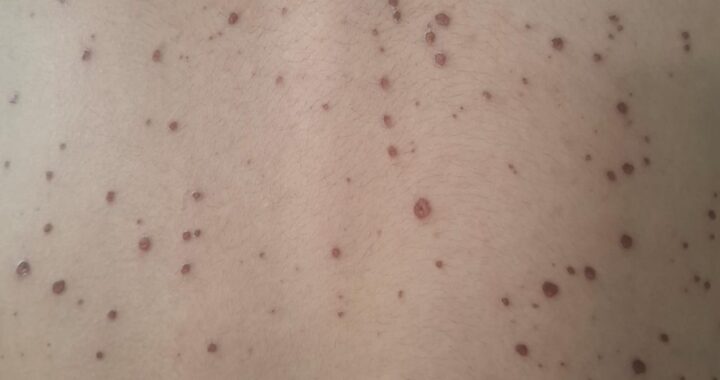 Afirma gobierno capitalino, que en el municipio no hay casos de sarampión