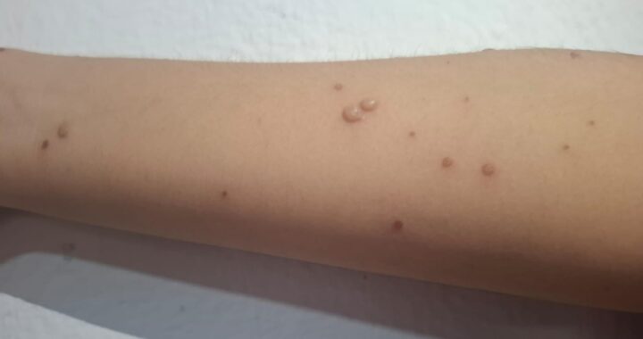 Ya son cinco casos de sarampión en el estado de Guanajuato